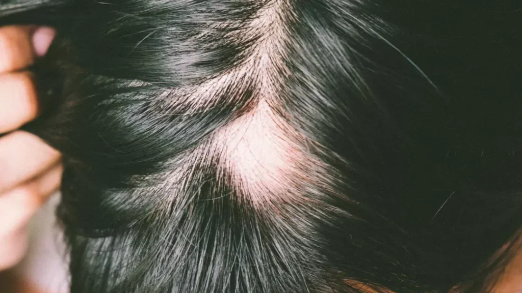 Qu&rsquo;est-ce qui provoque la perte de cheveux ?