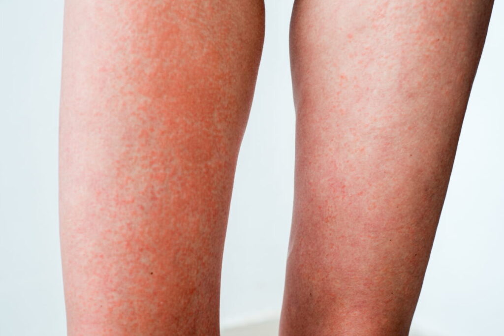 Combien de temps dure une allergie au soleil ?