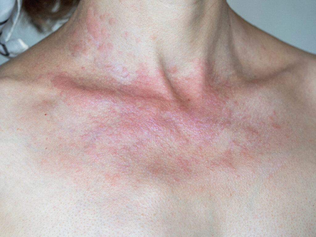Comment savoir si c’est une allergie au soleil ?