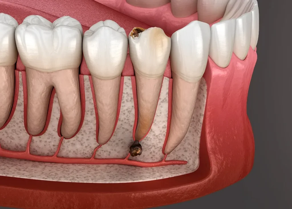 Quand s’inquiéter après une extraction dentaire ?