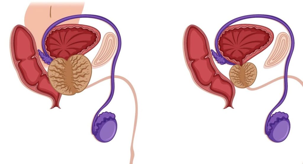 Quelles sont les complications de la prostatite ?