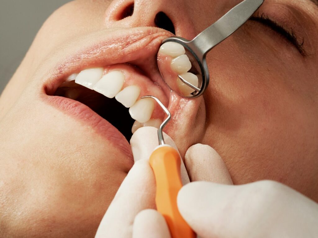 Soigner une carie sans dentiste : est-ce vraiment possible ?