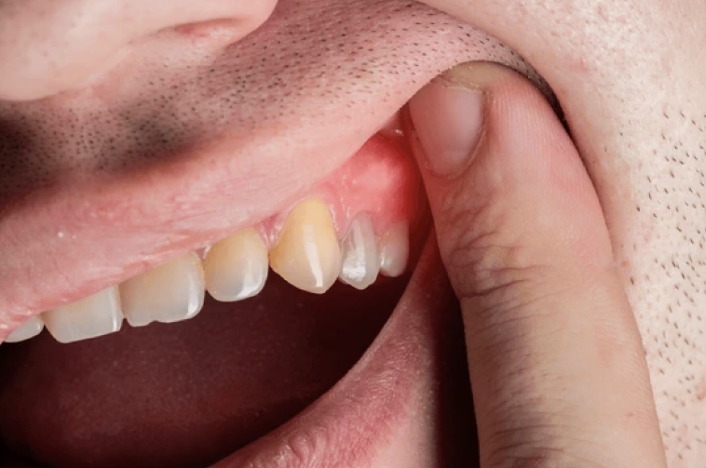 Les causes et complications d’un abcès dentaire non traité