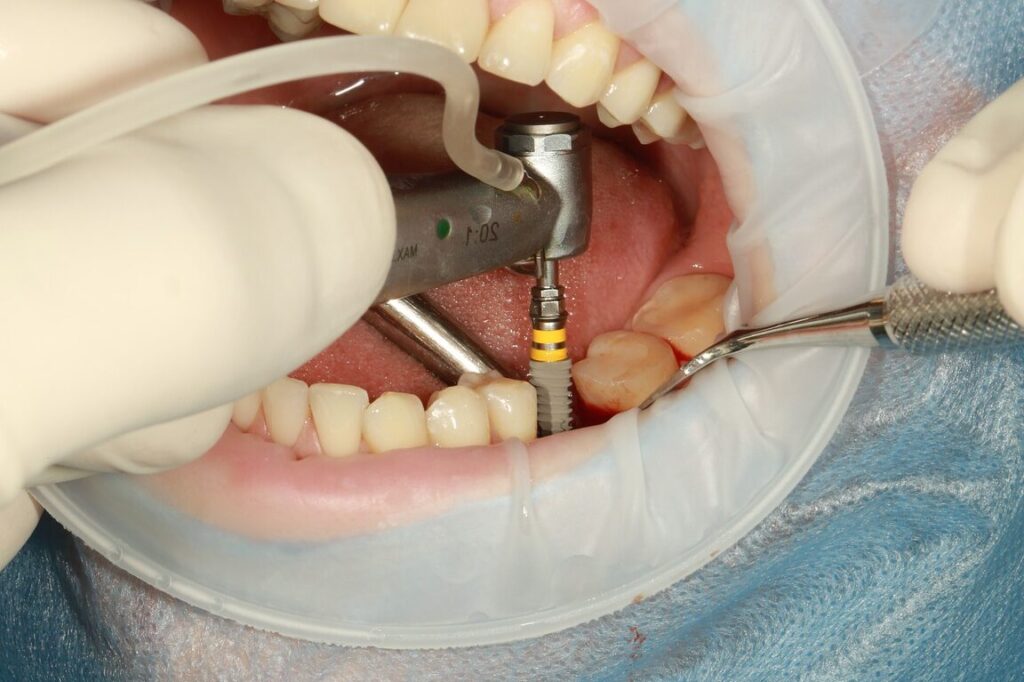 Quelle est la durée de vie d’un implant dentaire ?